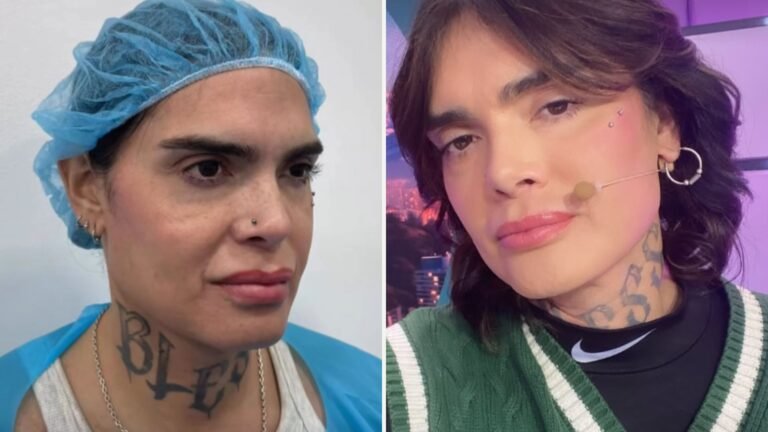 Nelson Mauri impacta tras someterse a retoque estético en el rostro: “Estoy feliz con el resultado”